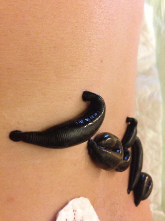 About Leech Therapy » Radiant Wellness Acupuncture